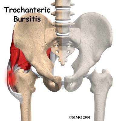 Greater Trochanteric Bursitis - Excel Spine